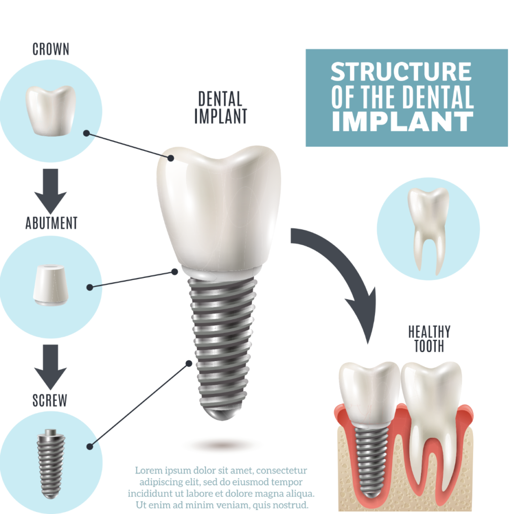 dental implants